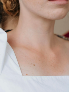 Sacramento Renuvion Neck Tightening