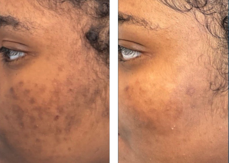 Microneedling procedure Antelope