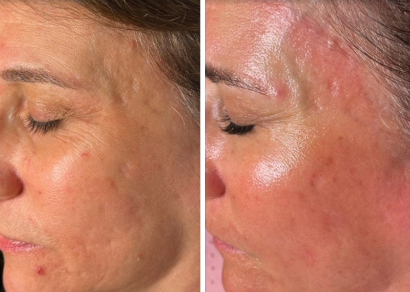 Microneedling results Antelope