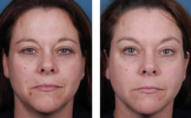 Chemical Peels Citrus-heights