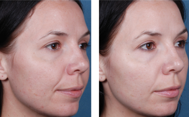 Chemical Peels procedure Citrus-heights