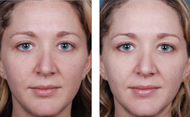 Chemical Peels Citrus-heights