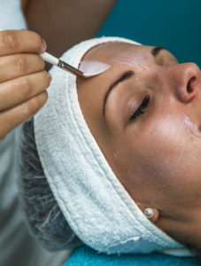 Elverta Chemical Peels