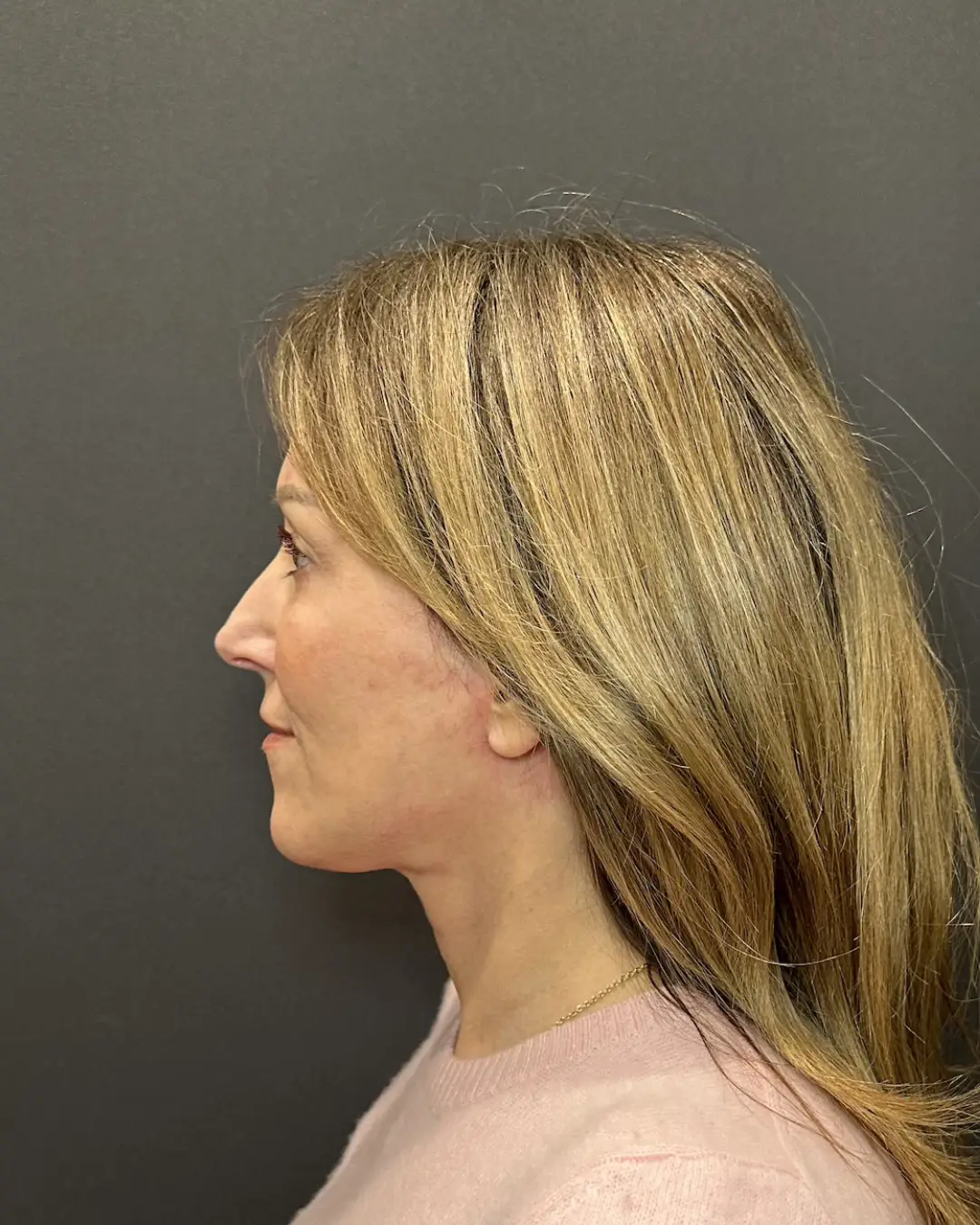 After Facelift Rocklin CA