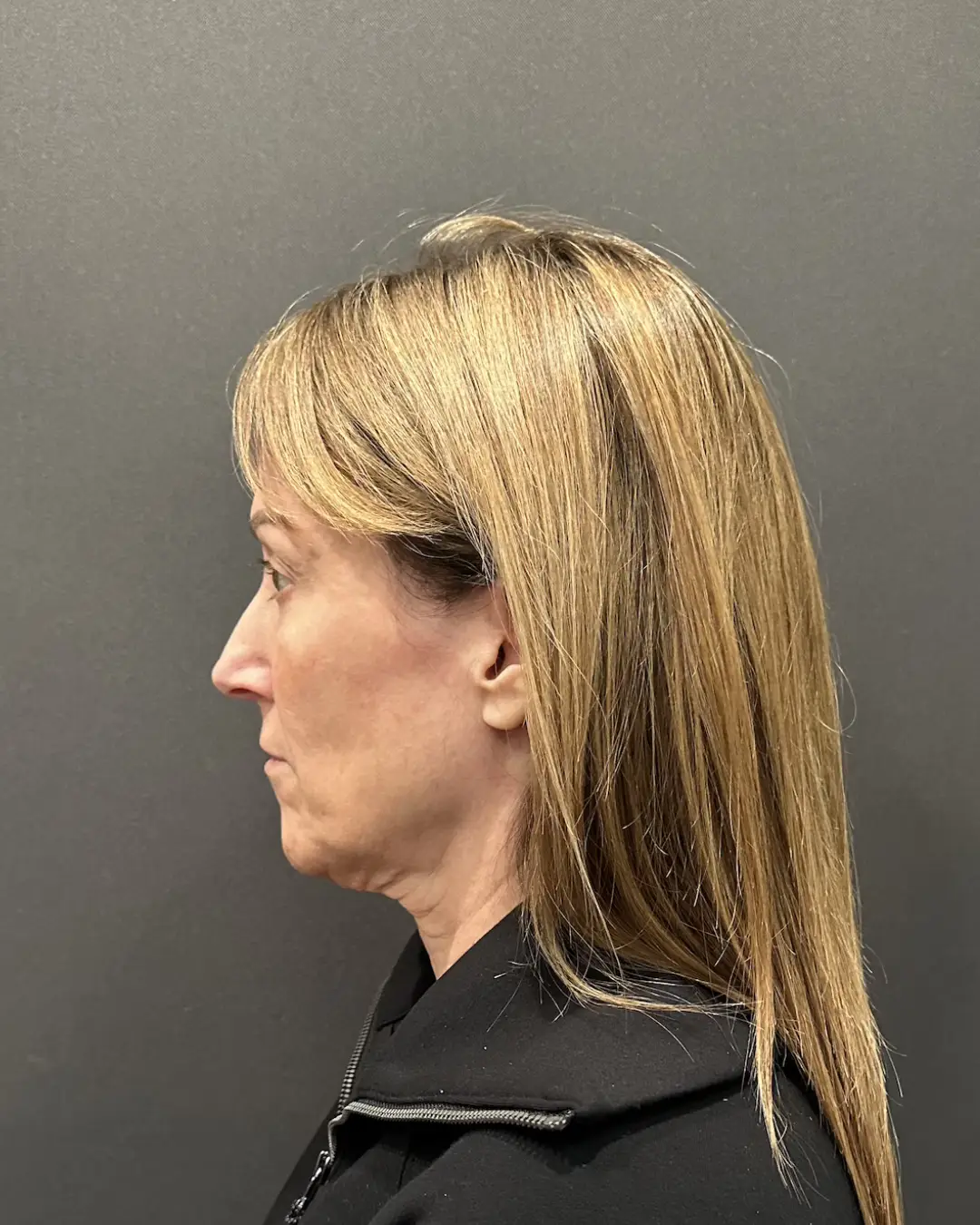 Before Facelift Rocklin CA