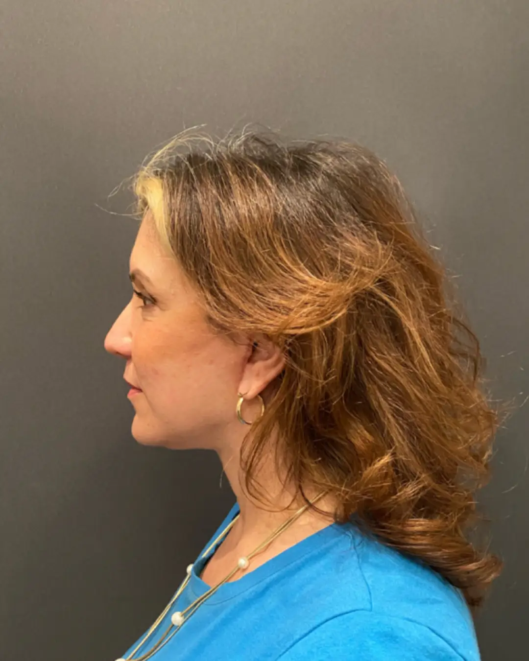 After Facelift Rocklin CA