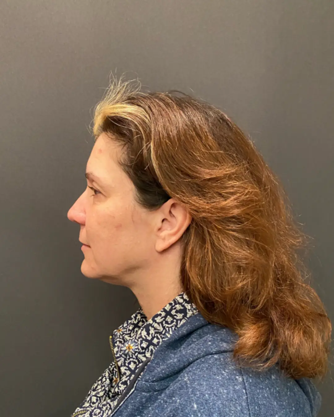 Before Facelift Rocklin CA
