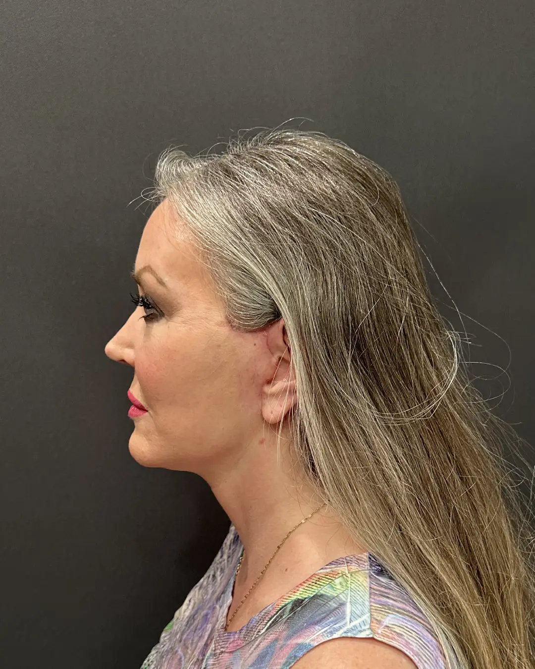 After Facelift Rocklin CA