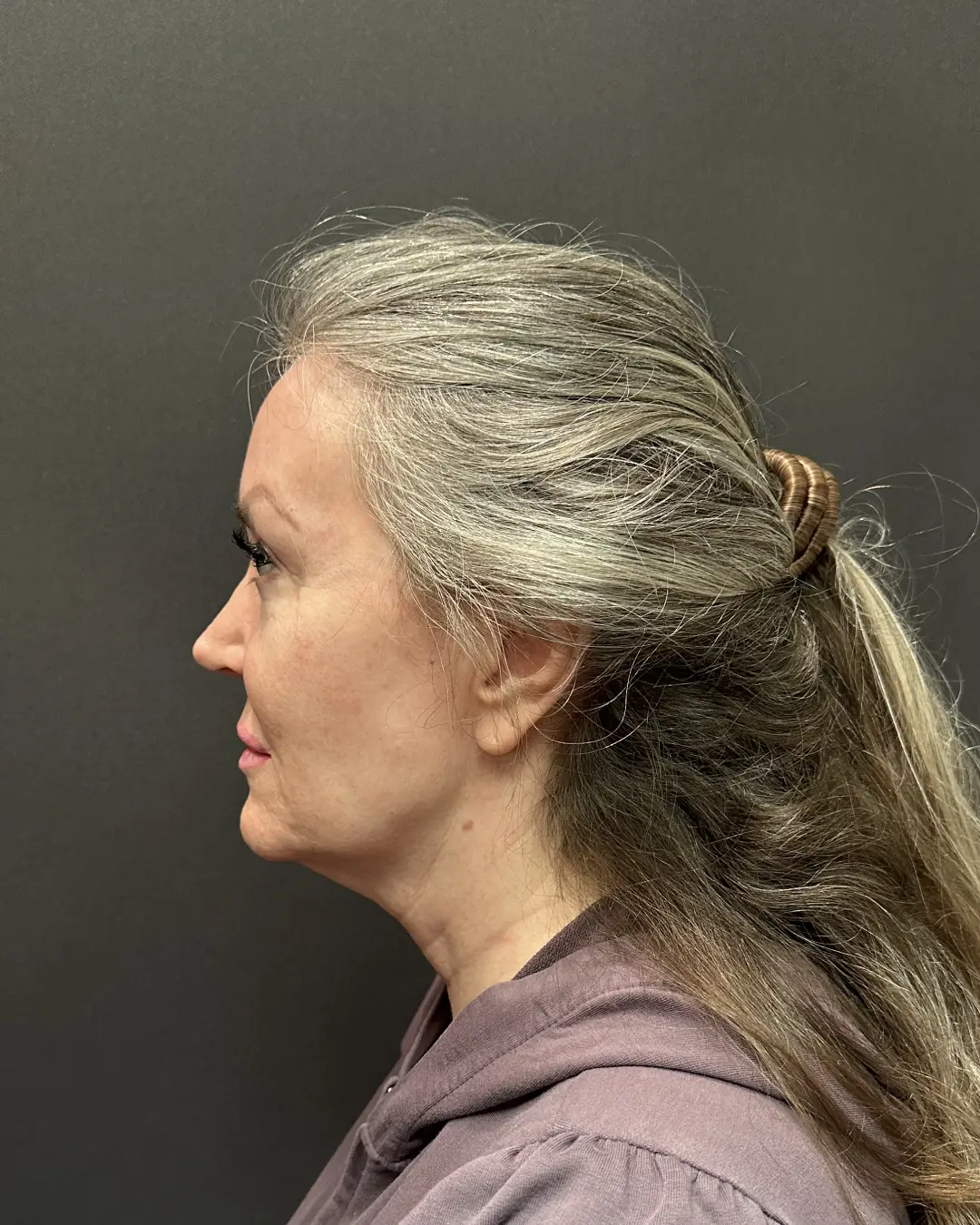 Before Facelift Rocklin CA