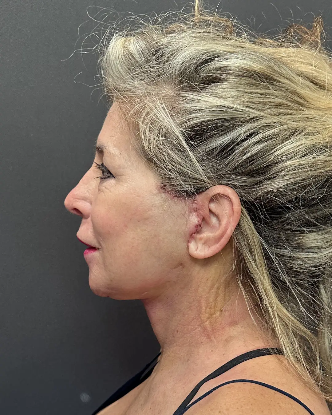 After Facelift Rocklin CA