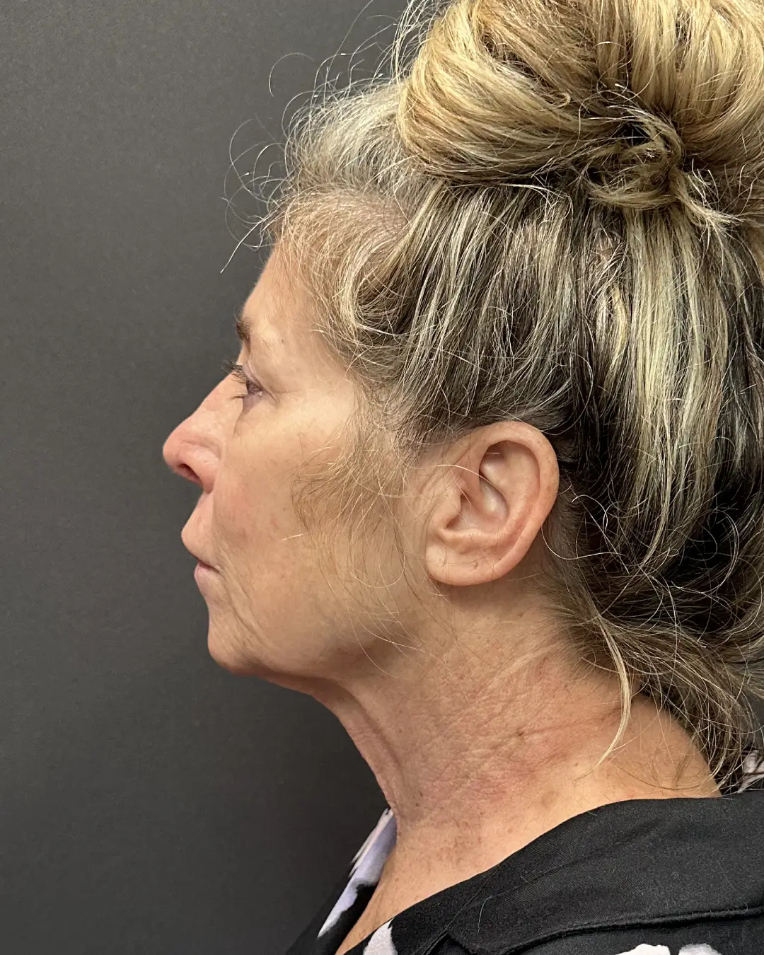 Before Facelift Rocklin CA