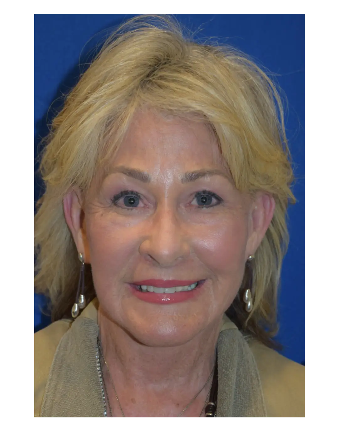 After Facelift Rocklin CA