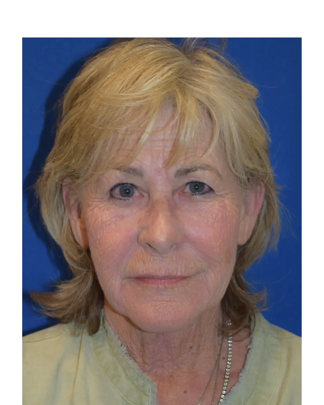 Before Facelift Rocklin CA