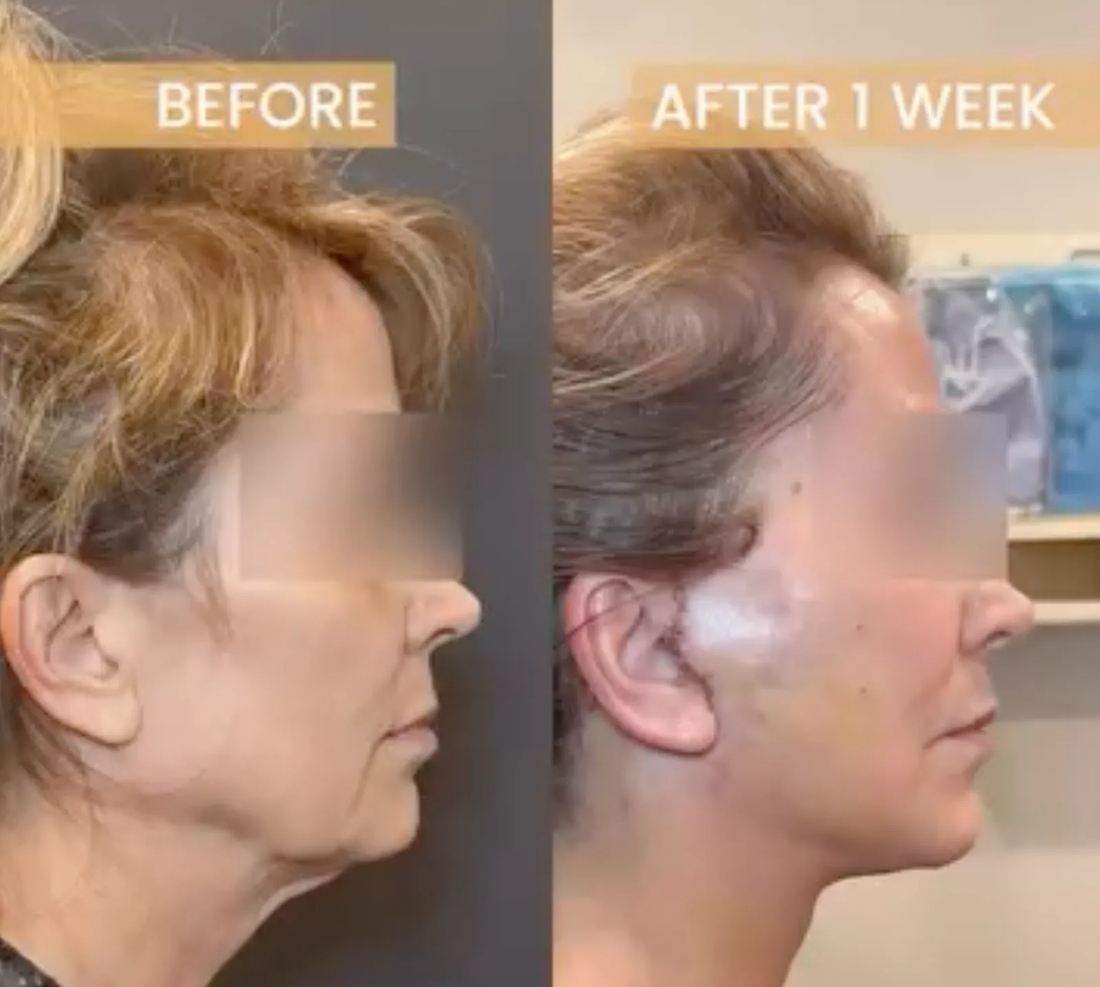 Side profile consultation for double chin treatment in Sacramento