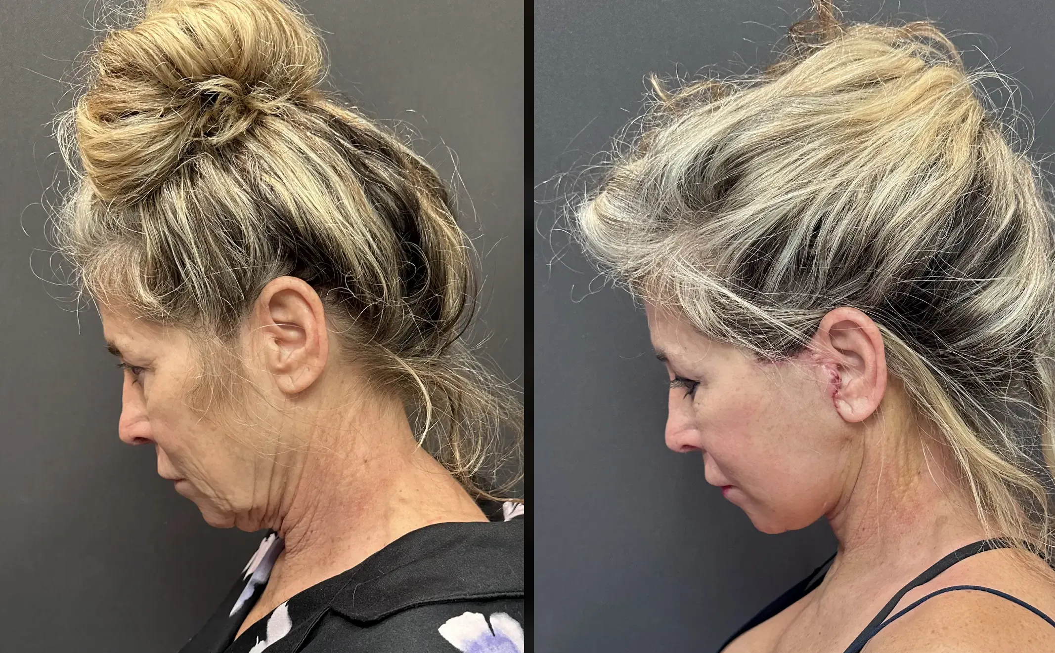 Before & After after General Face Surgery That includes neck lift