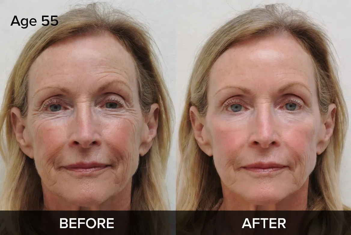 Botox example for Antelope